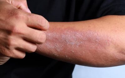 Dry Skin Tips, Prevention, and Causes